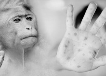 Reportan un caso de viruela del mono en Tamaulipas