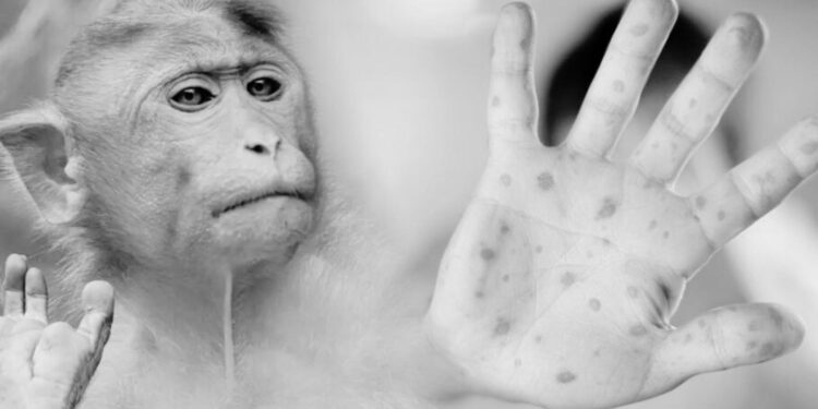 Reportan un caso de viruela del mono en Tamaulipas