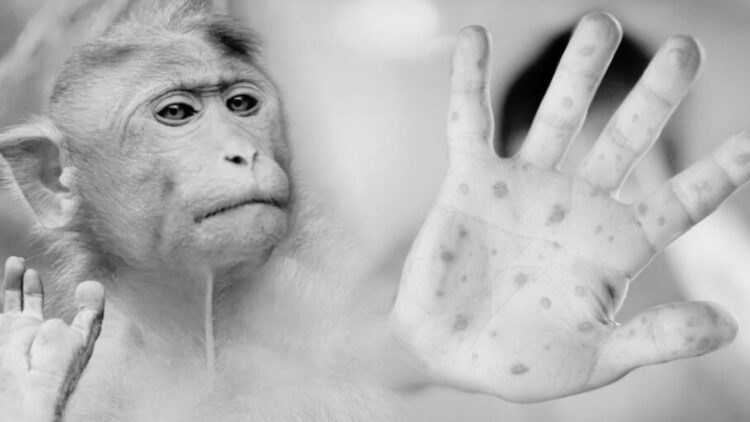 Reportan un caso de viruela del mono en Tamaulipas